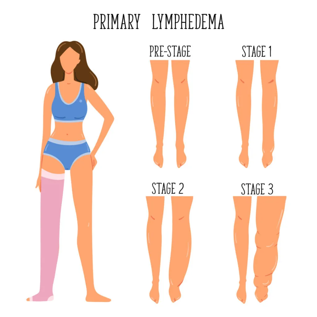 Primary Lymphedema stages. Lymphatic system disfunction. Elephantiasis, legs swelling disease. Young girl wearing compression stocking. Primary Lymphedema stages. Lymphatic system disfunction. Elephantiasis, legs swelling disease. Young girl wearing compression stocking.